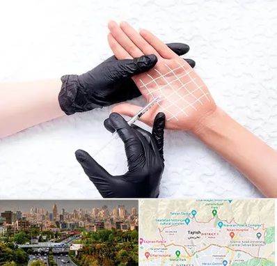 تزریق بوتاکس کف دست در منطقه 1 تهران 