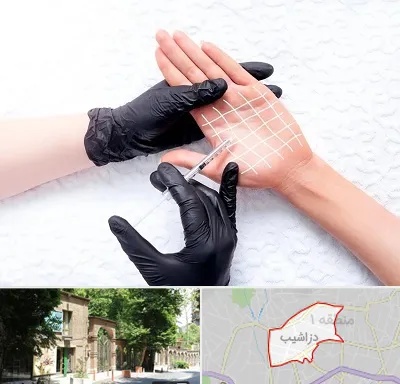 تزریق بوتاکس کف دست در دزاشیب