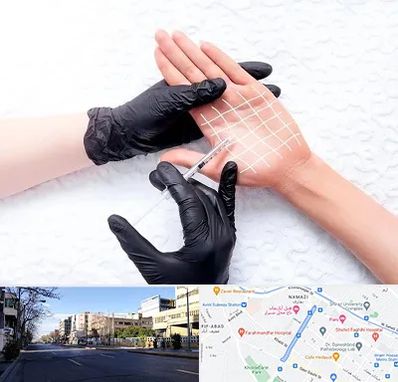 تزریق بوتاکس کف دست در خیابان ملاصدرا شیراز