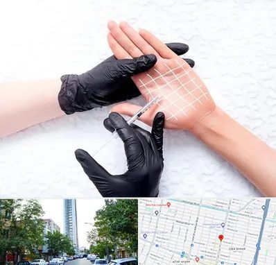 تزریق بوتاکس کف دست در امامت مشهد