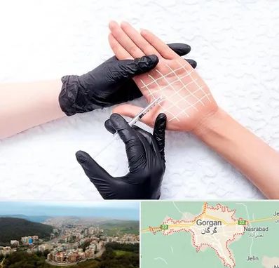 تزریق بوتاکس کف دست در گرگان