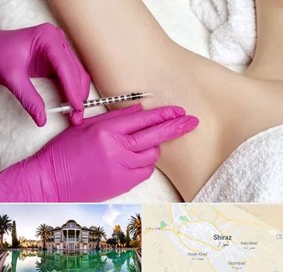 تزریق بوتاکس زیر بغل در شیراز