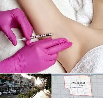 تزریق بوتاکس زیر بغل در خیابان جمالزاده