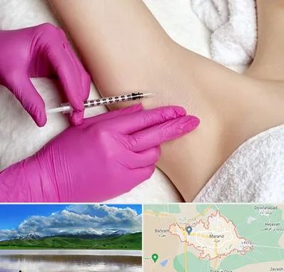 تزریق بوتاکس زیر بغل در مرند