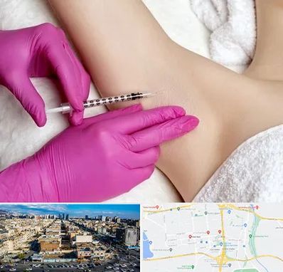 تزریق بوتاکس زیر بغل در شهرک راه آهن