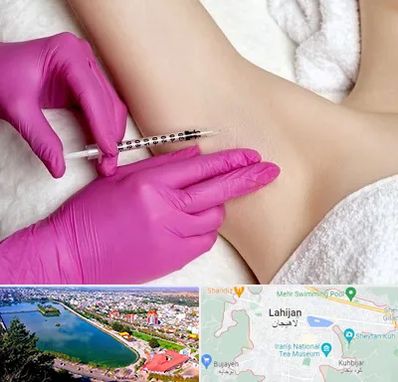 تزریق بوتاکس زیر بغل در لاهیجان