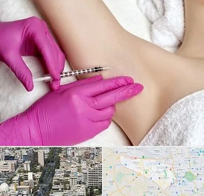 تزریق بوتاکس زیر بغل در منطقه 18 تهران 