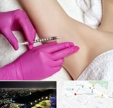 تزریق بوتاکس زیر بغل در هفت تیر مشهد