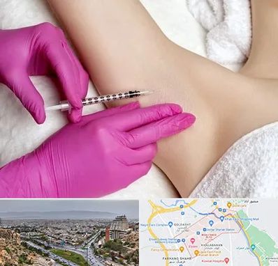 تزریق بوتاکس زیر بغل در معالی آباد شیراز