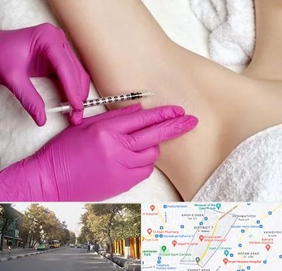 تزریق بوتاکس زیر بغل در شریعتی 