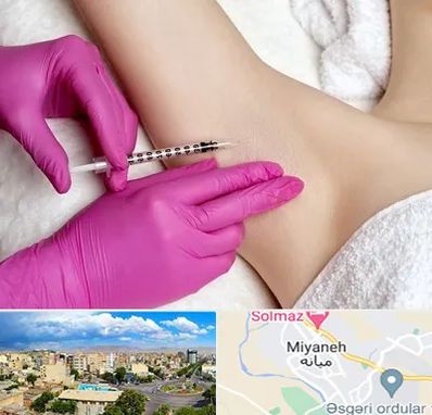 تزریق بوتاکس زیر بغل در میانه