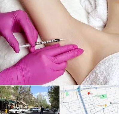 تزریق بوتاکس زیر بغل در کوی فیروز تبریز