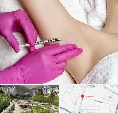 تزریق بوتاکس زیر بغل در بلوار تعاون