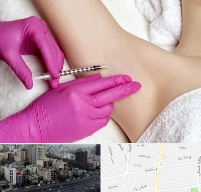 تزریق بوتاکس زیر بغل در زرتشت