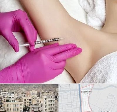 تزریق بوتاکس زیر بغل در اسکندری