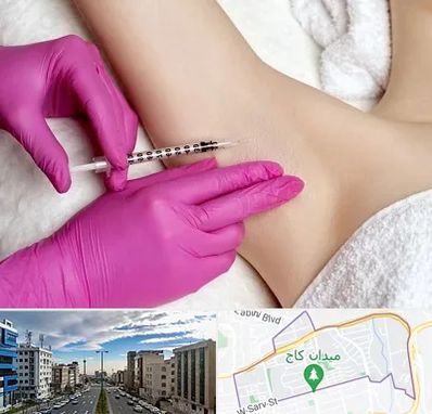 تزریق بوتاکس زیر بغل در سعادت آباد 