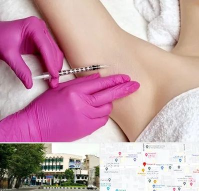 تزریق بوتاکس زیر بغل در طالقانی 