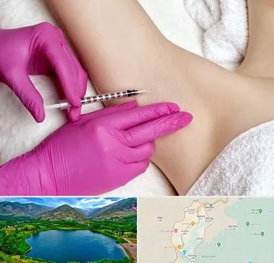 تزریق بوتاکس زیر بغل در رودبار