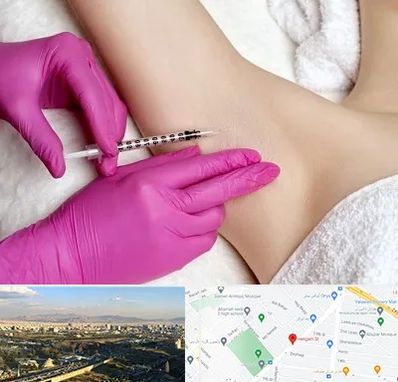 تزریق بوتاکس زیر بغل در هنگام 