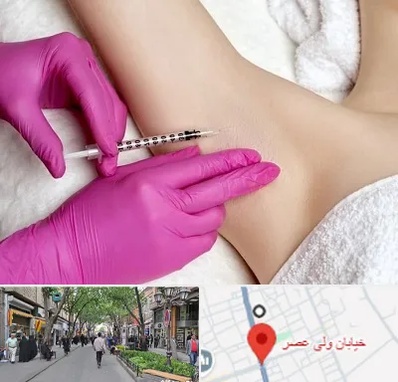 تزریق بوتاکس زیر بغل در ولیعصر شهریار