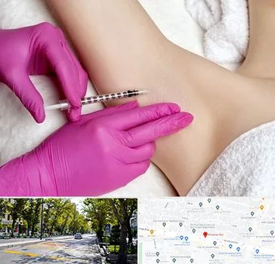 تزریق بوتاکس زیر بغل در میرداماد 