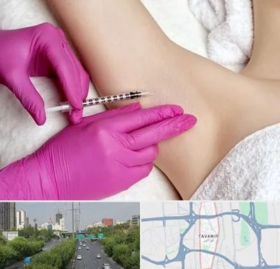 تزریق بوتاکس زیر بغل در توانیر