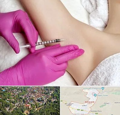 تزریق بوتاکس زیر بغل در دماوند