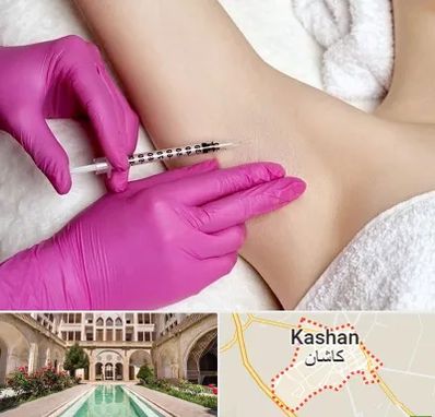 تزریق بوتاکس زیر بغل در کاشان