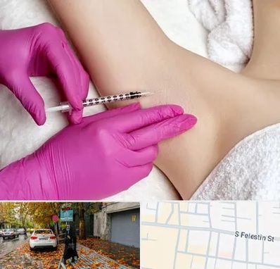 تزریق بوتاکس زیر بغل در خیابان فلسطین