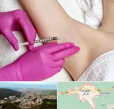 تزریق بوتاکس زیر بغل در گرگان