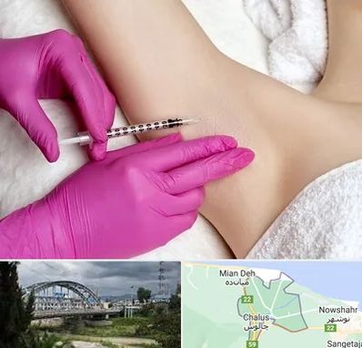 تزریق بوتاکس زیر بغل در چالوس