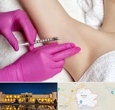 تزریق بوتاکس زیر بغل در برازجان