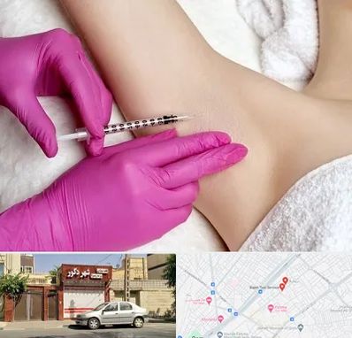 تزریق بوتاکس زیر بغل در باجک قم