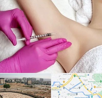 تزریق بوتاکس زیر بغل در کوی وحدت شیراز
