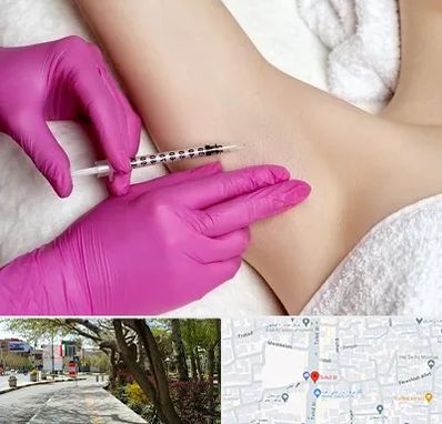 تزریق بوتاکس زیر بغل در خیابان توحید اصفهان