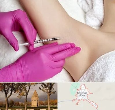 تزریق بوتاکس زیر بغل در تویسرکان