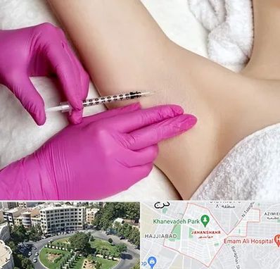 تزریق بوتاکس زیر بغل در جهانشهر کرج 