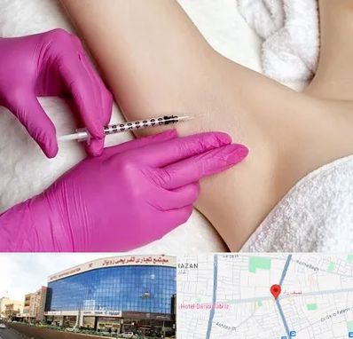 تزریق بوتاکس زیر بغل در نصف راه تبریز