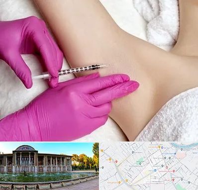 تزریق بوتاکس زیر بغل در عفیف آباد شیراز