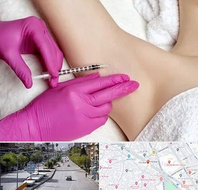 تزریق بوتاکس زیر بغل در خیابان زند شیراز