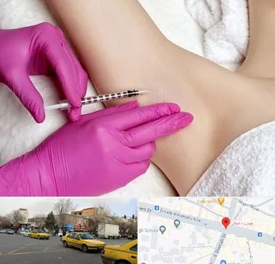 تزریق بوتاکس زیر بغل در شهناز تبریز