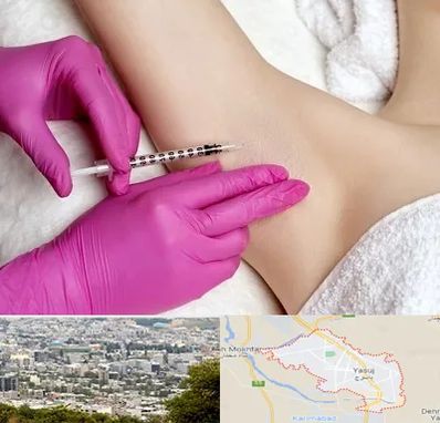 تزریق بوتاکس زیر بغل در یاسوج