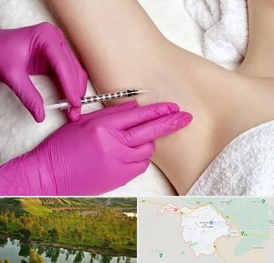 تزریق بوتاکس زیر بغل در بهبهان