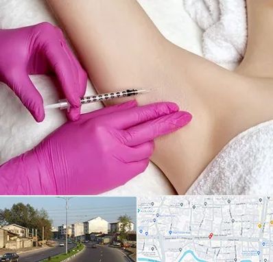 تزریق بوتاکس زیر بغل در ضیابری رشت