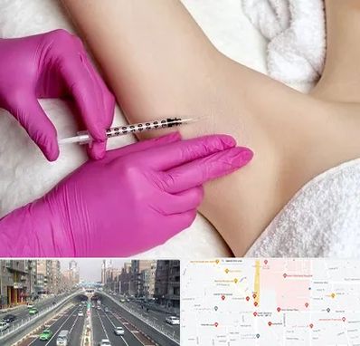 تزریق بوتاکس زیر بغل در توحید 