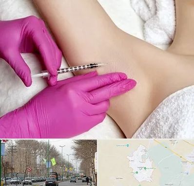 تزریق بوتاکس زیر بغل در نظرآباد کرج