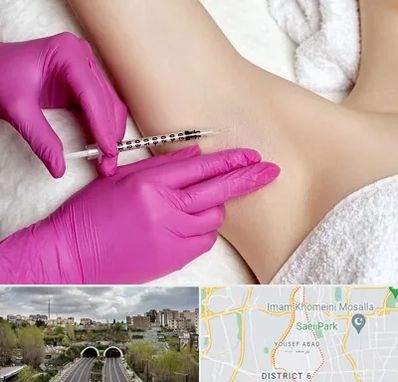 تزریق بوتاکس زیر بغل در یوسف آباد 