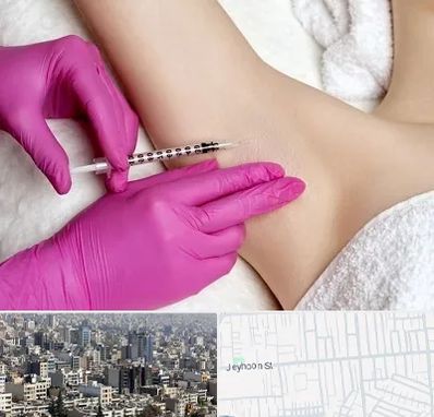 تزریق بوتاکس زیر بغل در جیحون