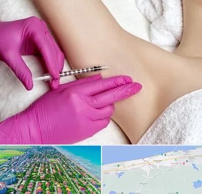 تزریق بوتاکس زیر بغل در فریدونکنار