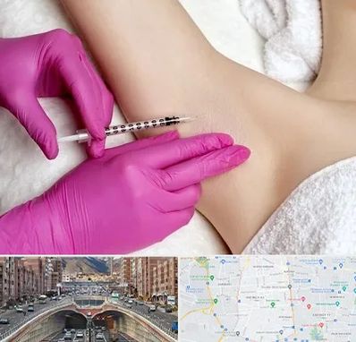 تزریق بوتاکس زیر بغل در منطقه 10 تهران 